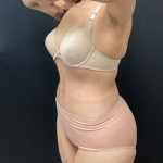 Abdominoplasty Before & After Patient #17072