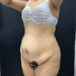 Abdominoplasty Before & After Patient #17072