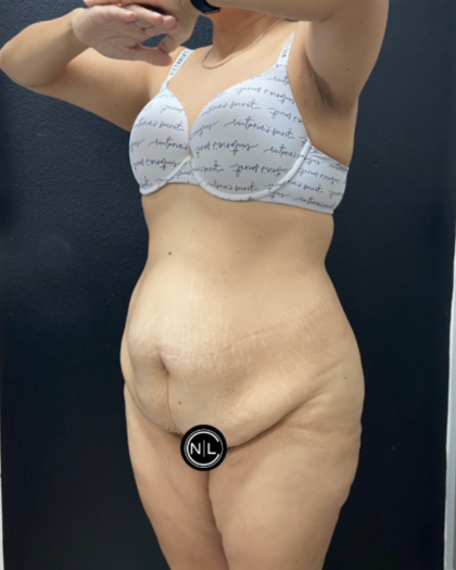 Abdominoplasty Before & After Patient #17072