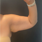 Brachioplasty Before & After Patient #17049