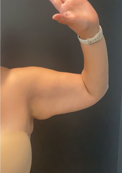 Brachioplasty Before & After Patient #17049