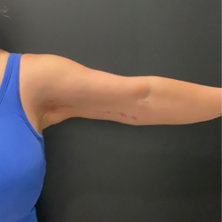 Brachioplasty Before & After Patient #17049