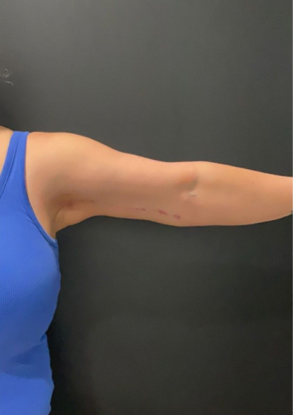 Brachioplasty Before & After Patient #17049