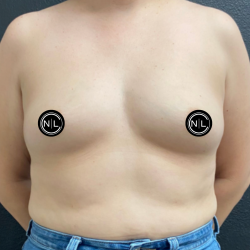 Breast Augmentation Before & After Patient #17050