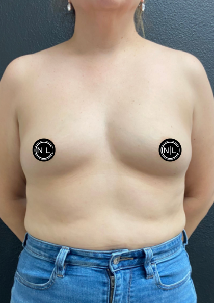 Breast Augmentation Before & After Patient #17050