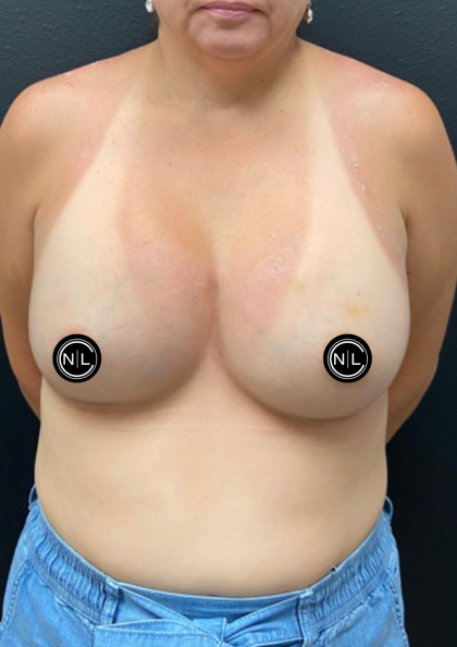 Breast Augmentation Before & After Patient #17050