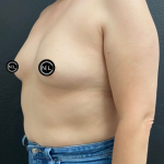 Breast Augmentation Before & After Patient #17050