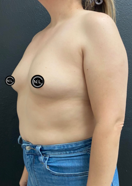Breast Augmentation Before & After Patient #17050