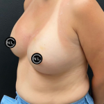 Breast Augmentation Before & After Patient #17050