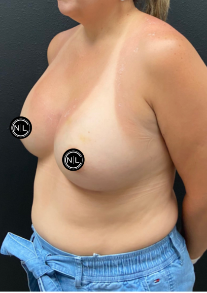 Breast Augmentation Before & After Patient #17050