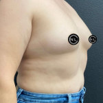 Breast Augmentation Before & After Patient #17050