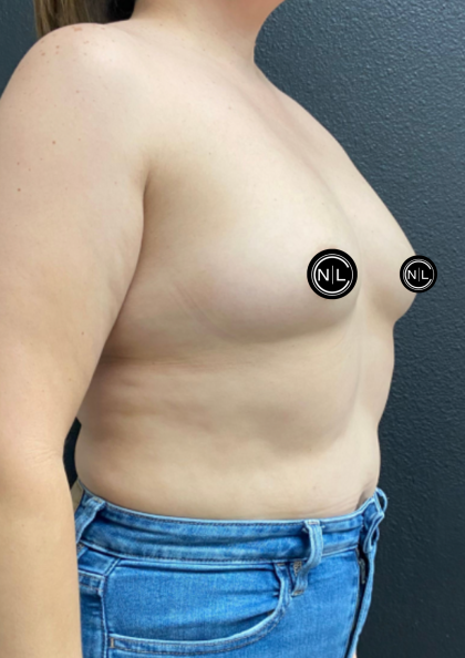 Breast Augmentation Before & After Patient #17050