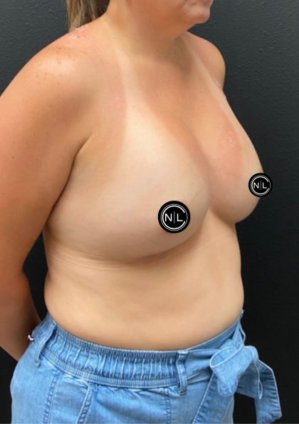 Breast Augmentation Before & After Patient #17050