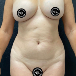 Breast Explants Before & After Patient #17051