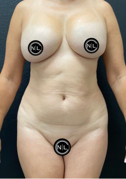 Breast Explants Before & After Patient #17051