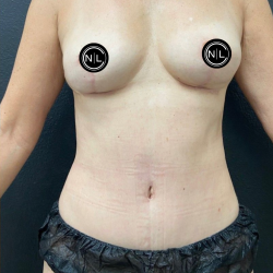 Breast Explants Before & After Patient #17051