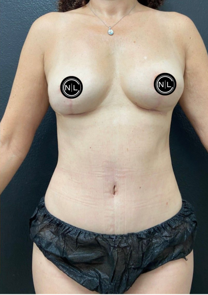 Breast Explants Before & After Patient #17051
