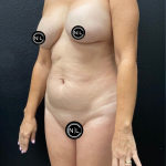 Breast Explants Before & After Patient #17051