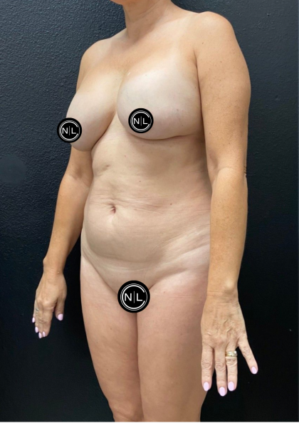 Breast Explants Before & After Patient #17051