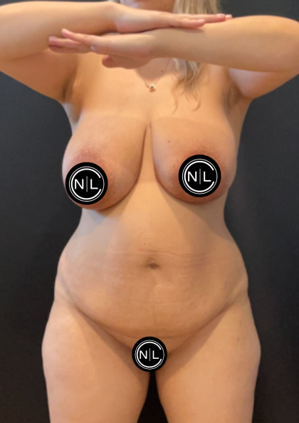Breast Lift Before & After Patient #17052
